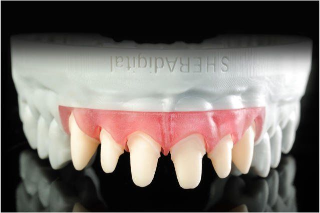 Gingiva