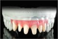 Gingiva